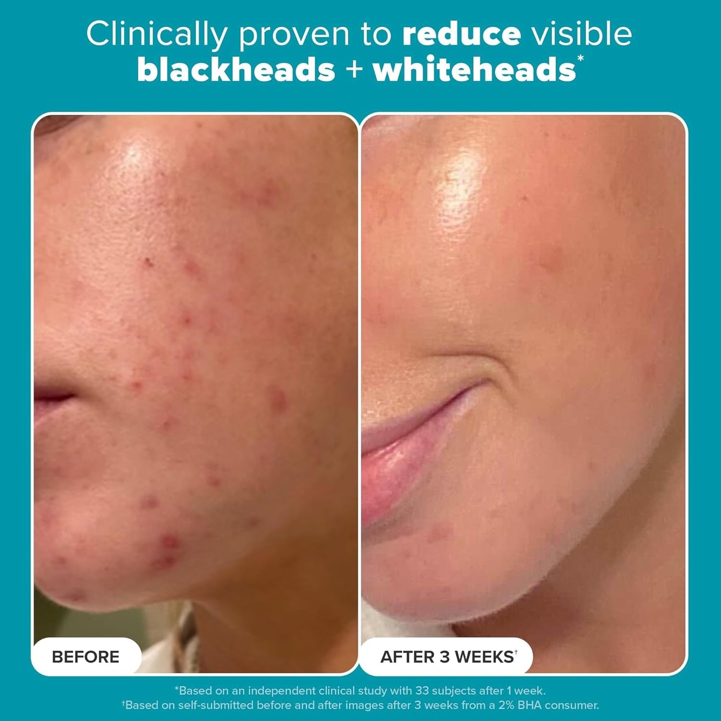 Paula's Choice Skin Perfecting 2% BHA Liquid Salicylic Acid Exfoliant