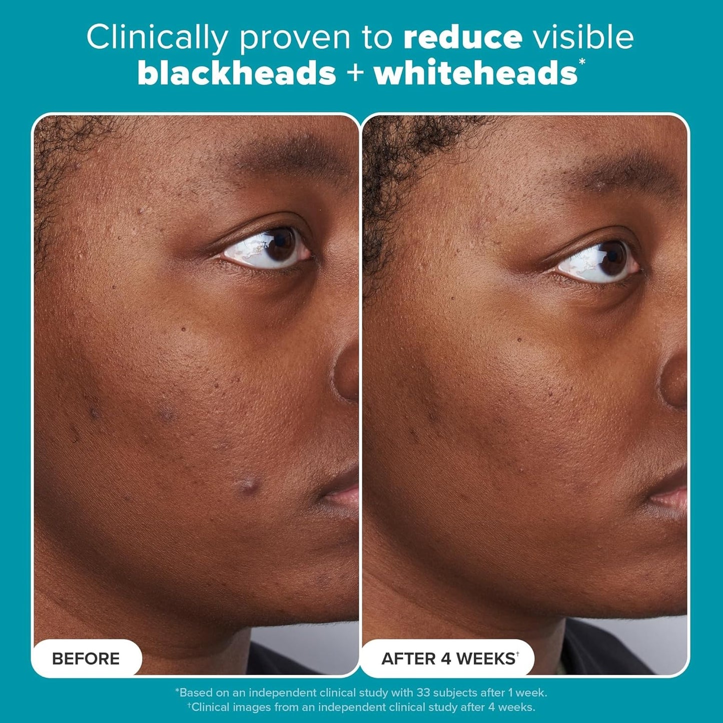 Paula's Choice Skin Perfecting 2% BHA Liquid Salicylic Acid Exfoliant